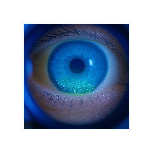 Close-up of human eye under blue light showing dry eye diagnostic staining