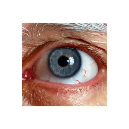 Close-up of human eye with redness and visible blood vessels, symptoms of eye irritation